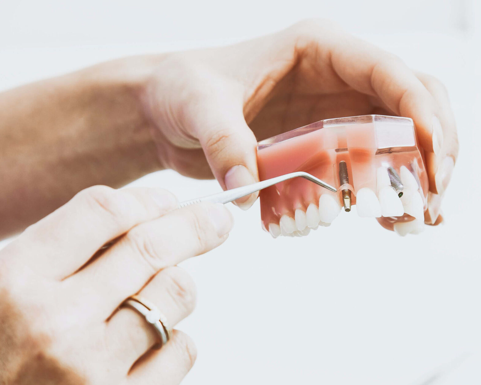 Dental Implants Franklin Implant Dentist, MA Arcadia Dental