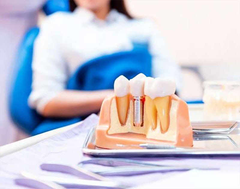 Single Tooth Replacement